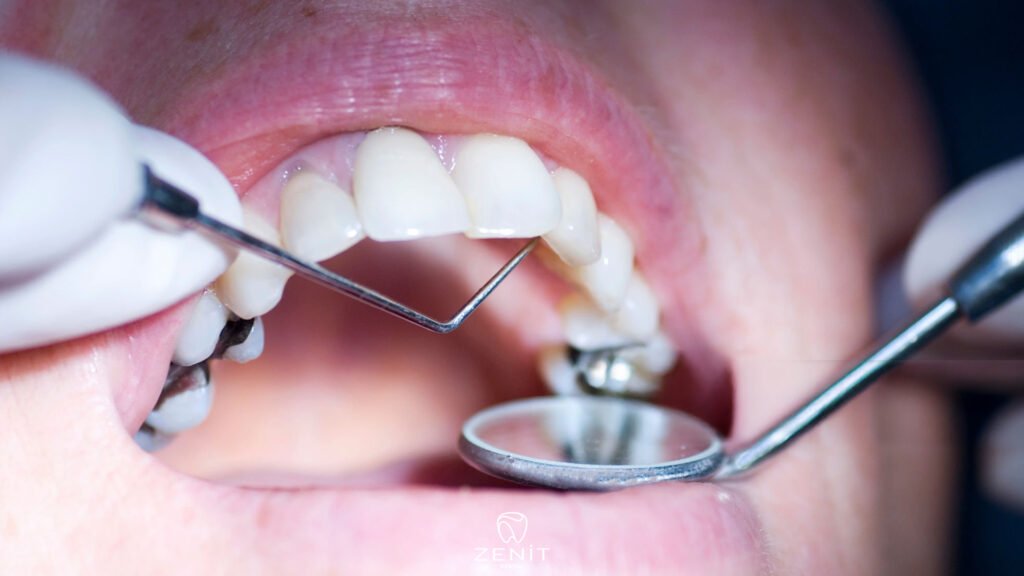 Does a Filled Tooth Decay?