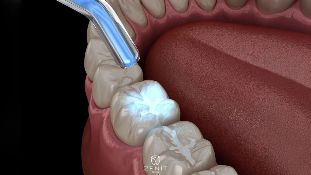 What is a Fissure Sealant