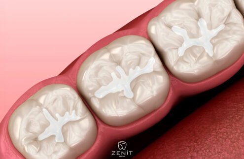 Fissür Örtücü Nedir