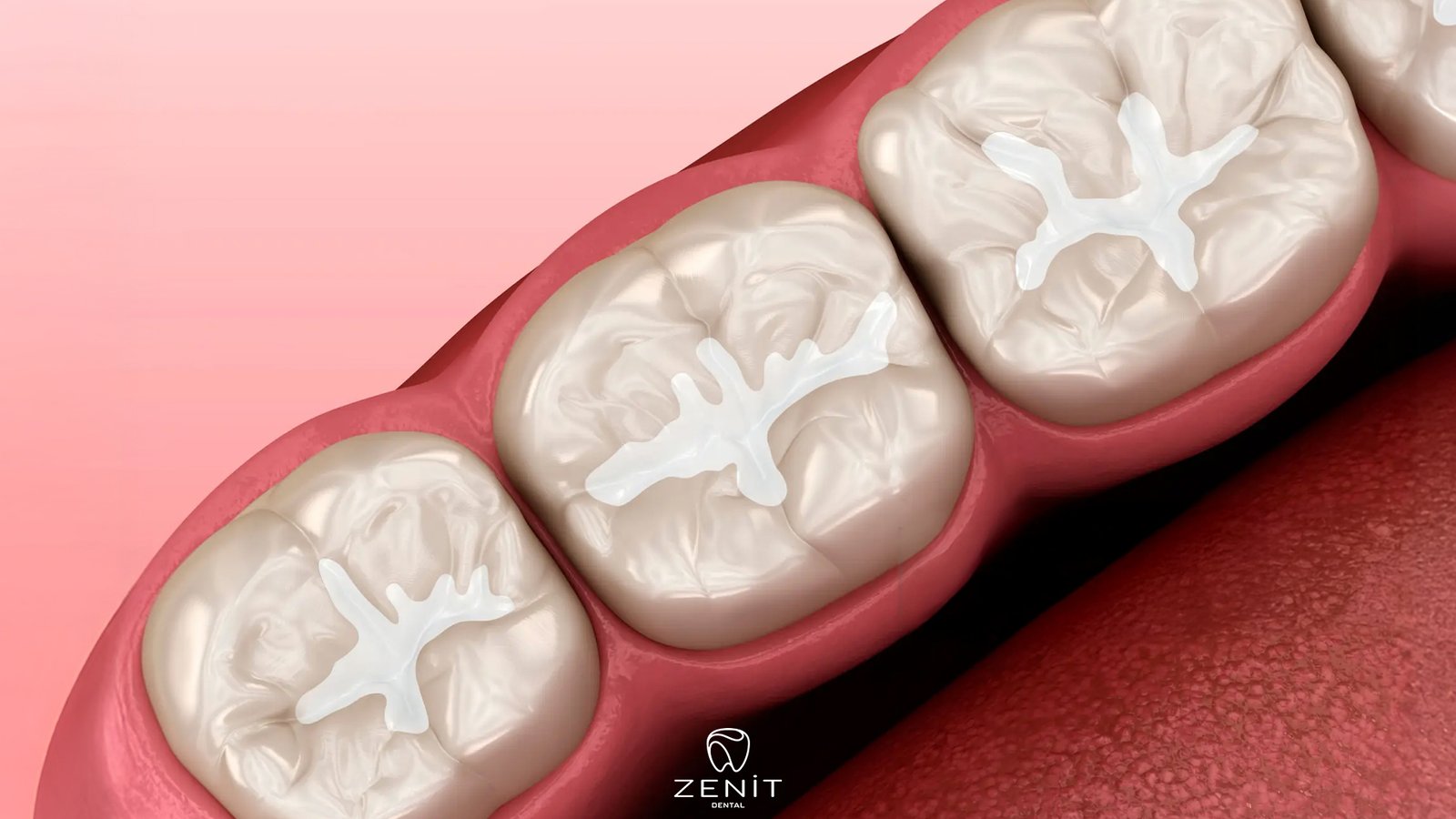 Fissür Örtücü Nedir