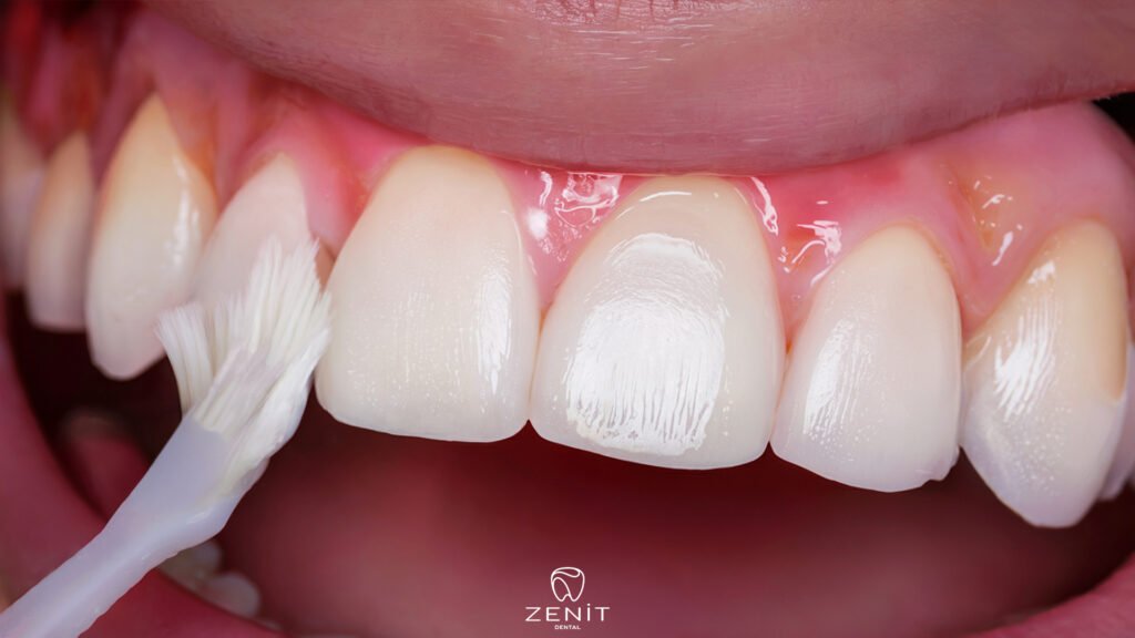 Koruyucu Diş Hekimliği Nedir