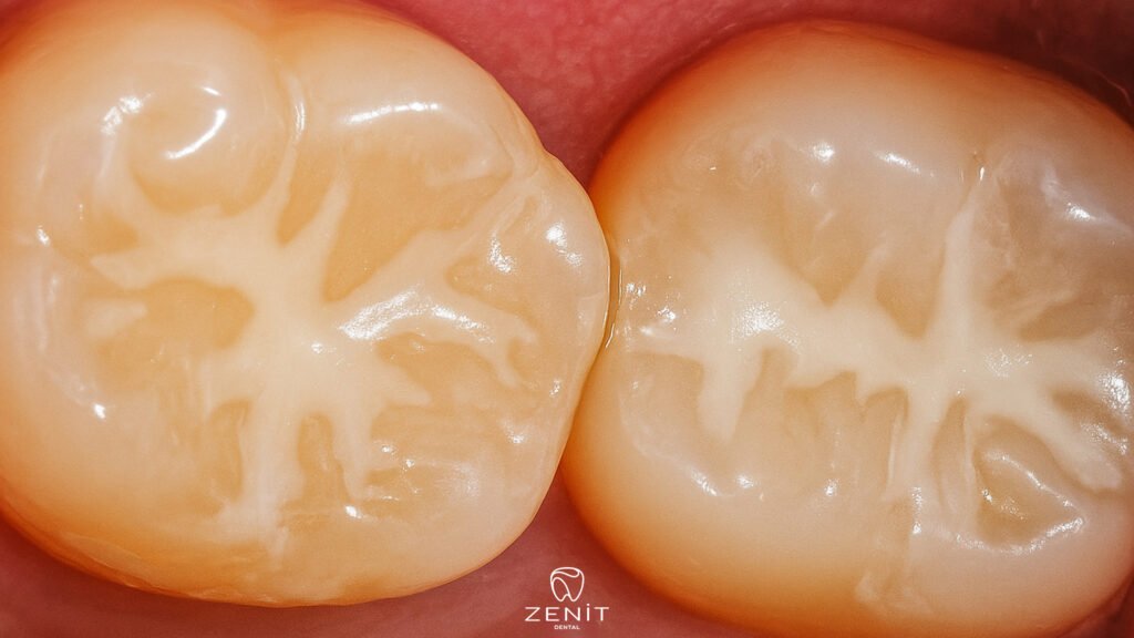 Koruyucu Diş Hekimliği Nedir