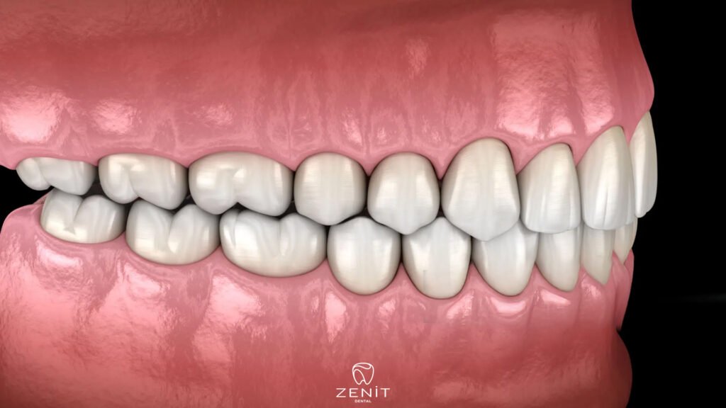 What is Orthognathic Surgery?