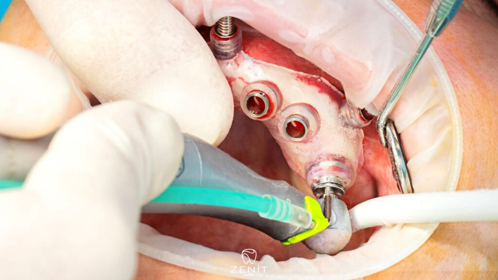 What is a Surgical Guide