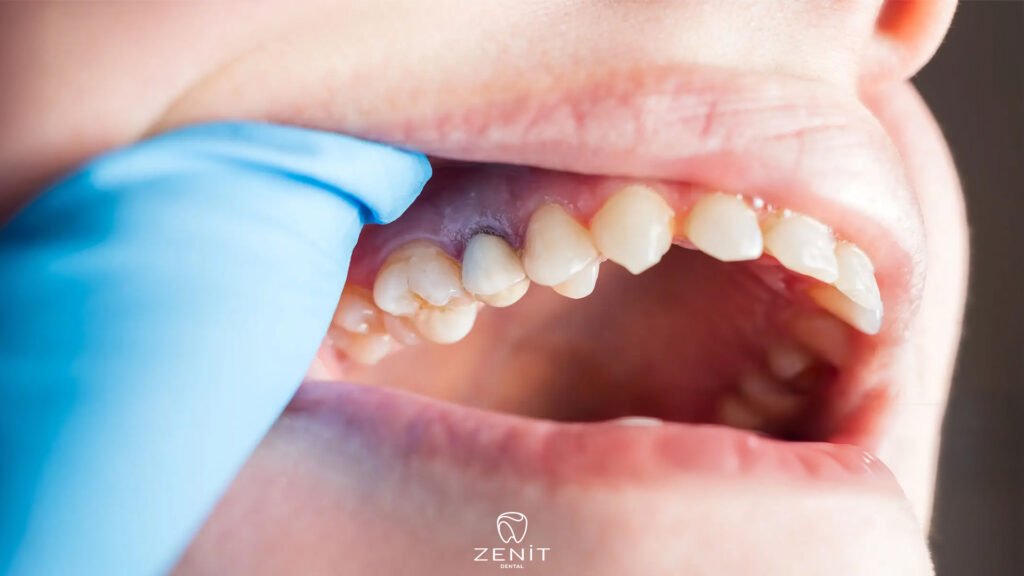 Can the Tooth Under a Crown Decay