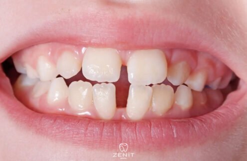 Diastema Nedir