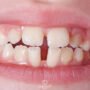 Diastema Nedir 1 90x90