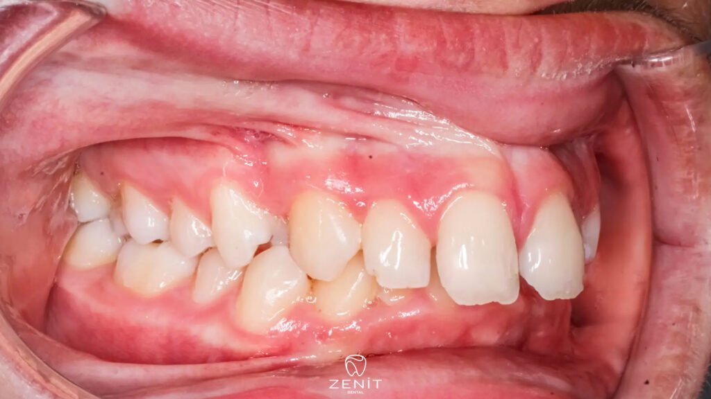 What is Diastema