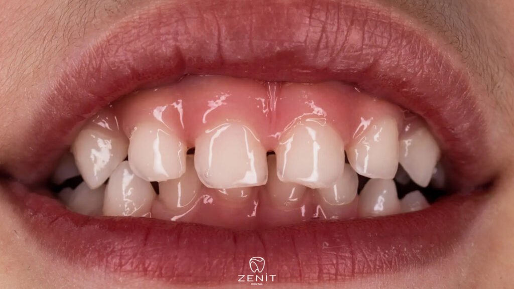 What is Diastema