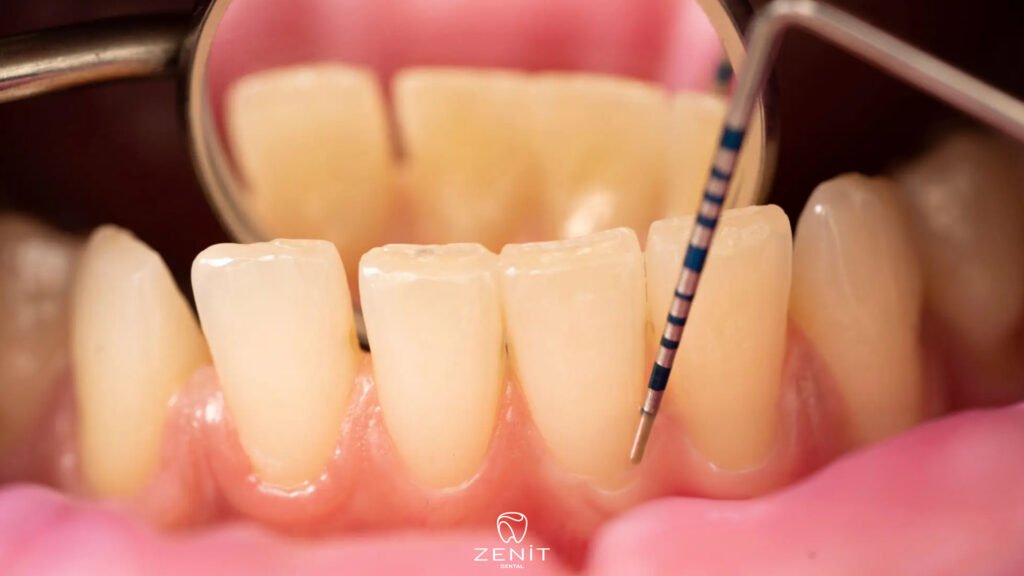 What Happens If Tartar Is Not Removed
