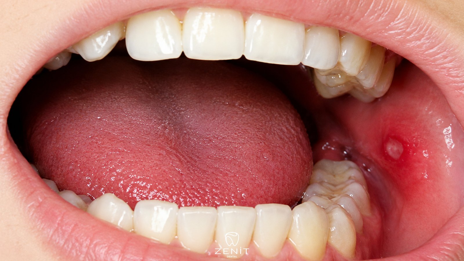 What Causes Mouth Sores