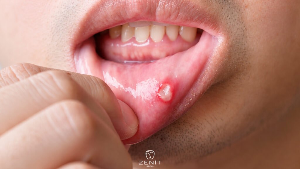 What Causes Mouth Sores