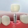 Gebze implant tedavisi 2 90x90