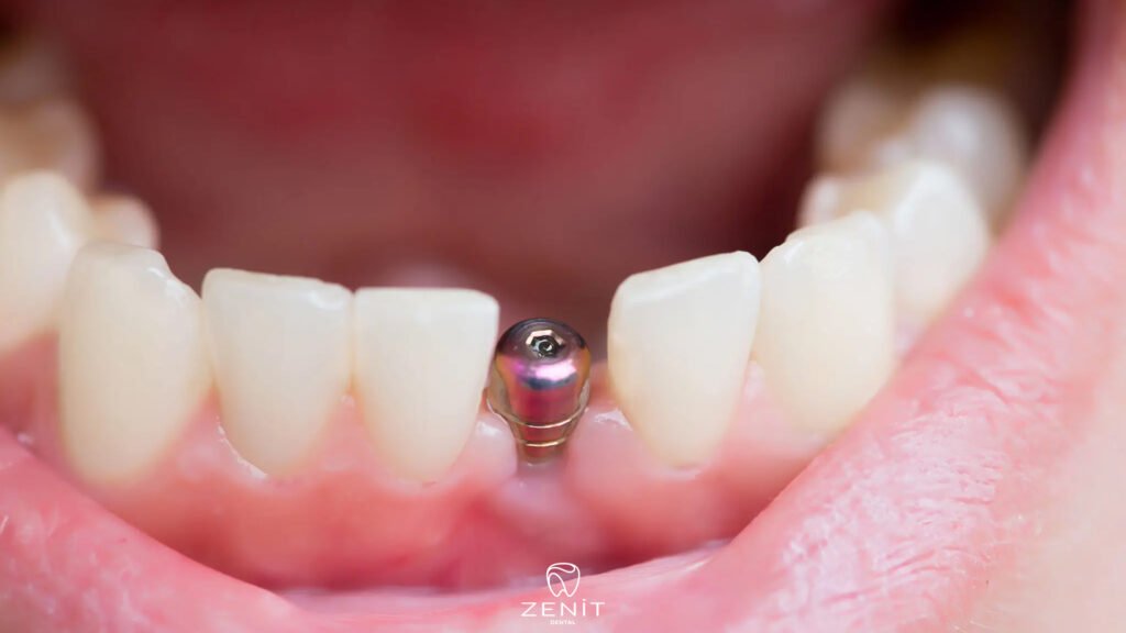 Dental Implants in Turkey