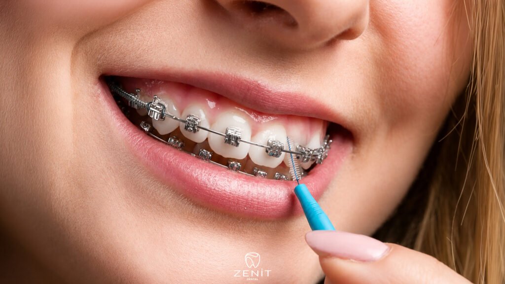 How to Use an Interdental Brush