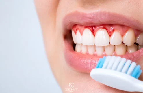 What Causes Bleeding Gums? Symptoms and Treatment