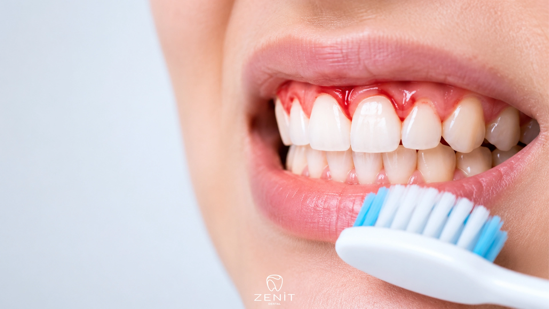 What Causes Bleeding Gums? Symptoms and Treatment