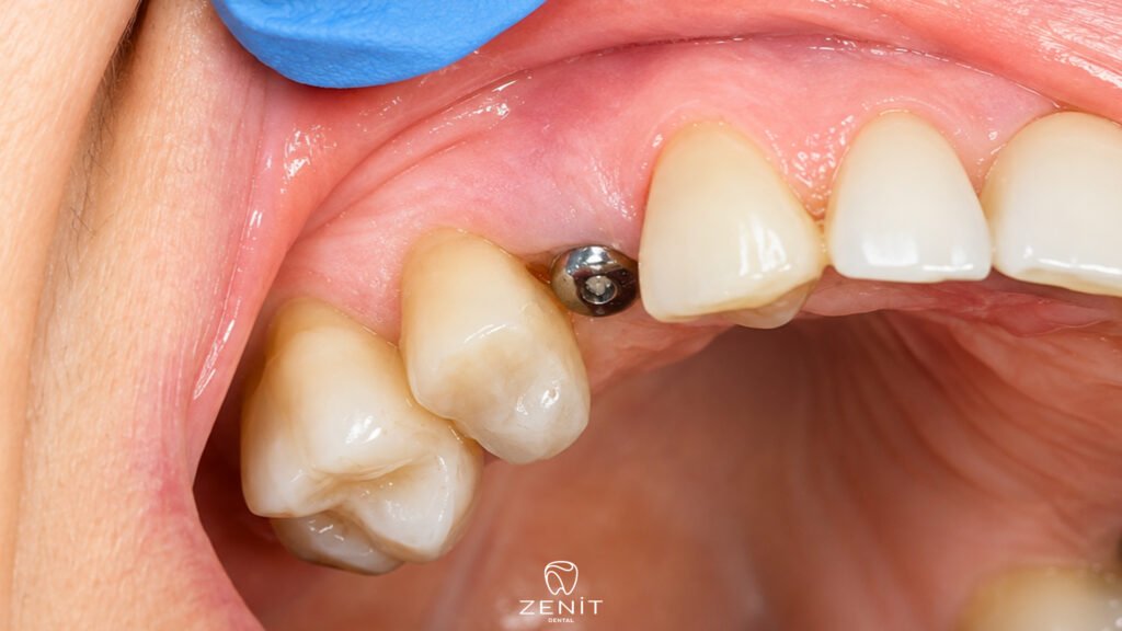 Gebze İmplant Fiyatları