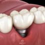 implant tedavisi 90x90