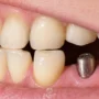 implantin omru ne kadardir implant ne zaman yenilenir 2 90x90