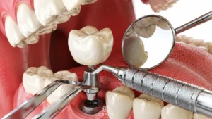 How Long Do Dental Implants Last? When Should an Implant Be Replaced?