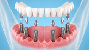 Implant-Supported Prosthesis: Fixed vs. Removable