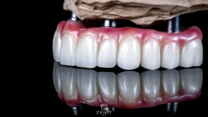 Implant-Supported Prosthesis: Fixed vs. Removable
