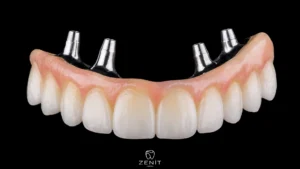 Implant-Supported Prosthesis: Fixed vs. Removable