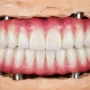 implant ustu protez nedir sabit ve hareketli protezler arasindaki farklar 4 90x90
