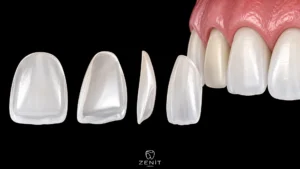 How Long Do Laminate Veneers Last? Lifespan Guide