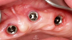 Swelling and Pain After Dental Implant: Is It Normal?