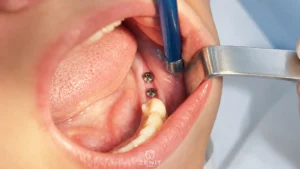 Swelling and Pain After Dental Implant: Is It Normal?