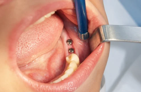 Swelling and Pain After Dental Implant: Is It Normal?