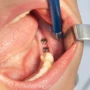 implant sonrasi sislik ve agri normal mi_ iyilesme sureci nasil ilerler 2 90x90